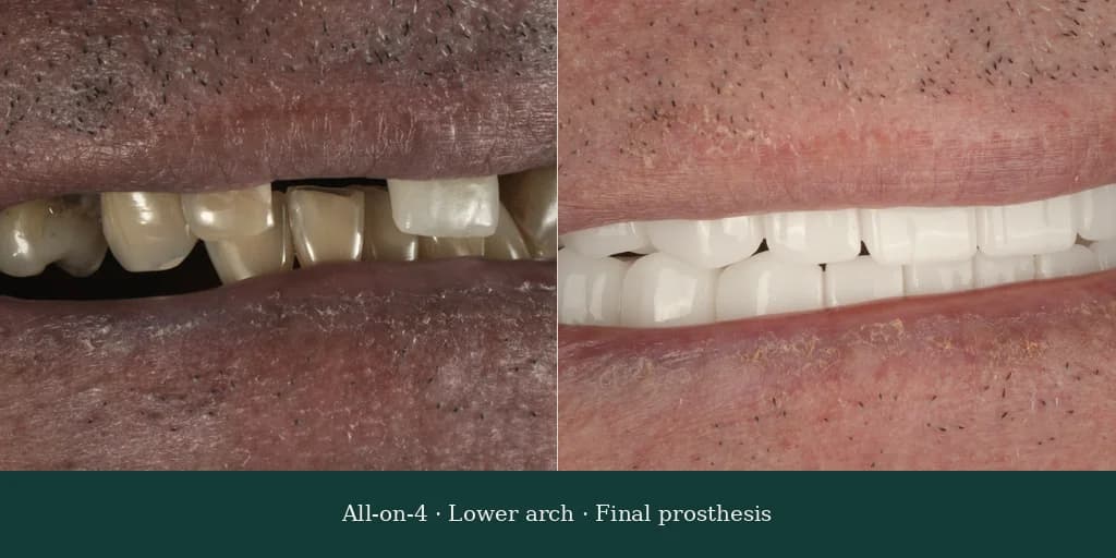 All-on-4 lower arch — final implant-supported prosthesis