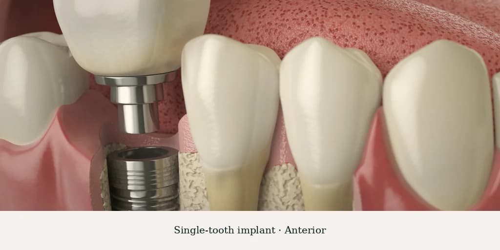 Single-tooth implant — anterior, six-month post-op result