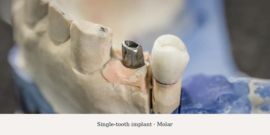 Single-tooth implant — molar, six-month post-op result
