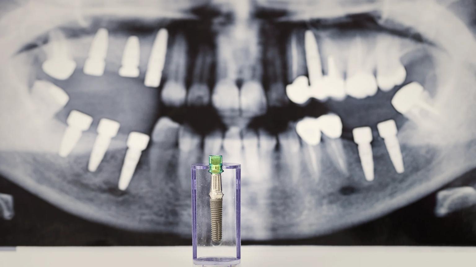 Full-arch implant surgical suite at an ATDERA Care Network partner facility in Turkey, configured for CBCT planning and immediate-loading prosthesis fitting