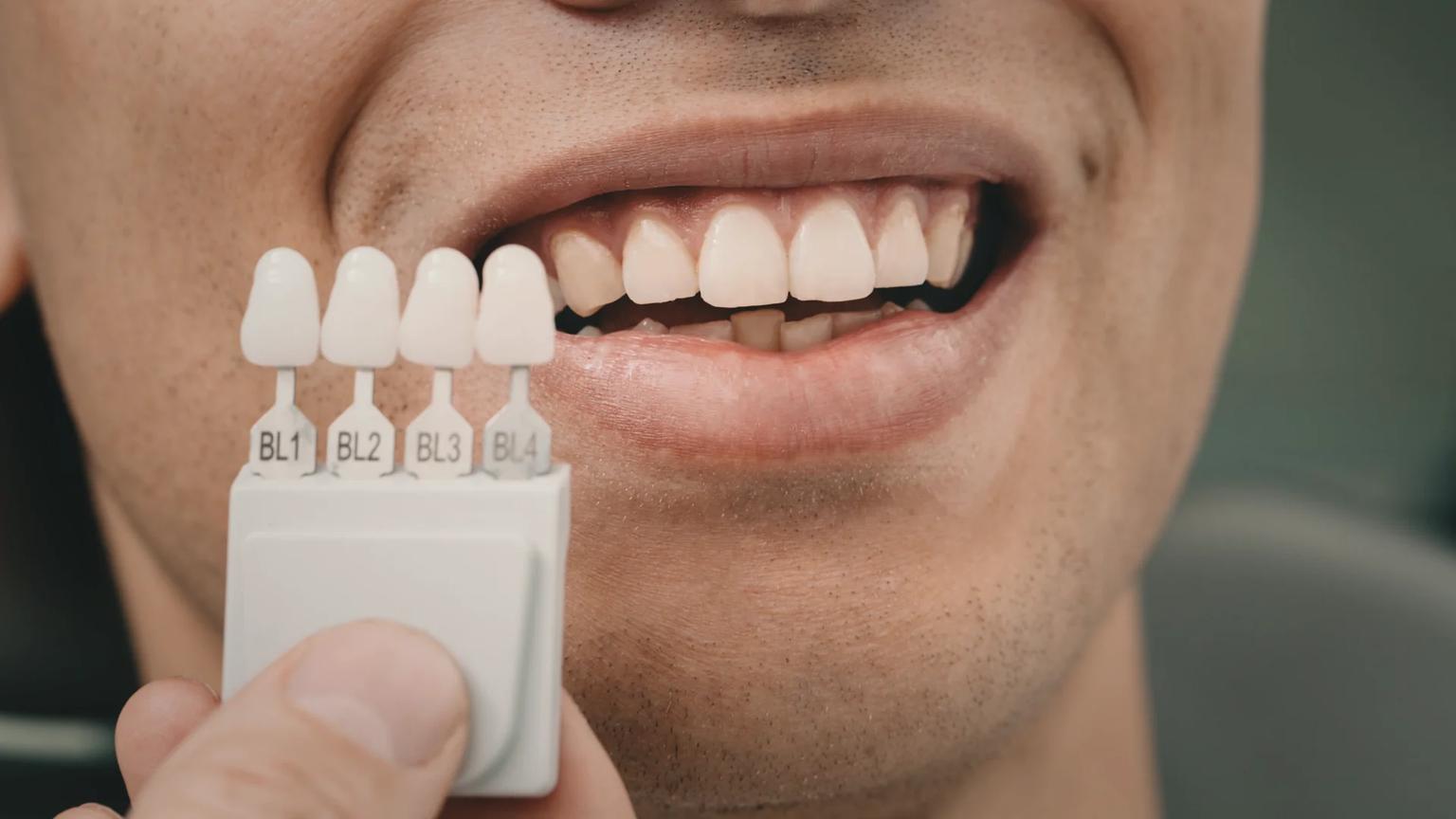 Bloc de dentisterie esthétique dans un établissement partenaire du réseau de soins ATDERA en Turquie, configuré pour le design numérique du sourire, l’appariement de teinte et le collage des facettes en porcelaine
