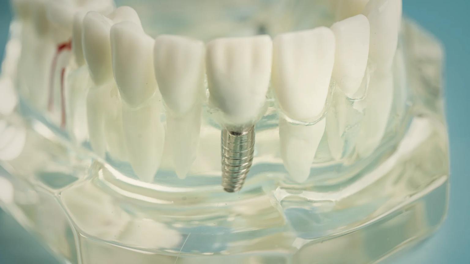 Bloc chirurgical d’implant dentaire unitaire dans un établissement partenaire du réseau de soins ATDERA en Turquie, configuré pour la pose guidée par CBCT et la restauration par couronne céramique