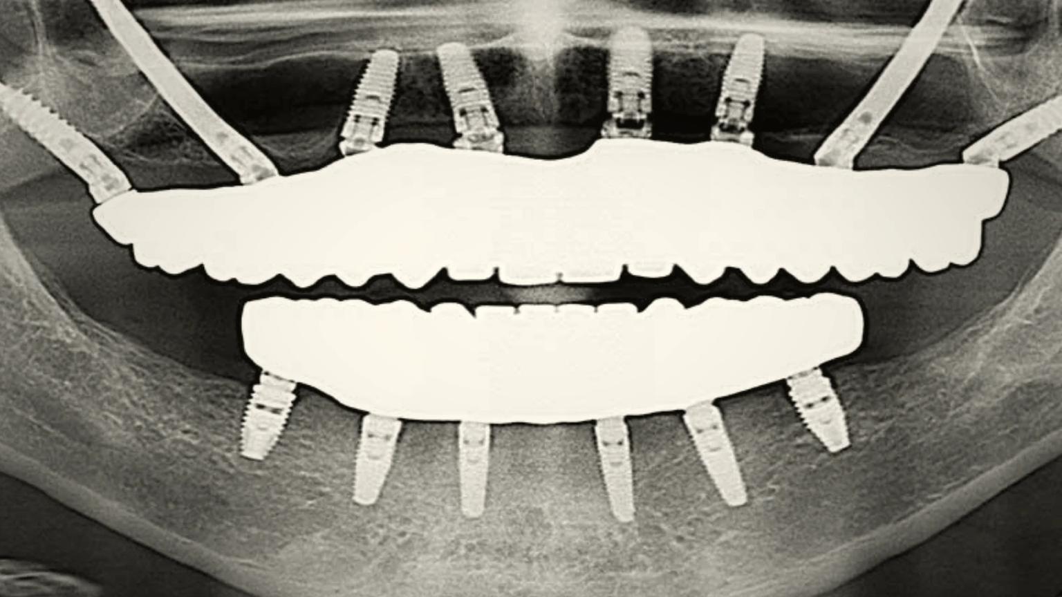 Maxillofacial surgical suite at an ATDERA Care Network partner facility in Turkey, configured for CBCT-planned zygomatic implant anchorage in the zygomatic bone for severely resorbed maxilla cases