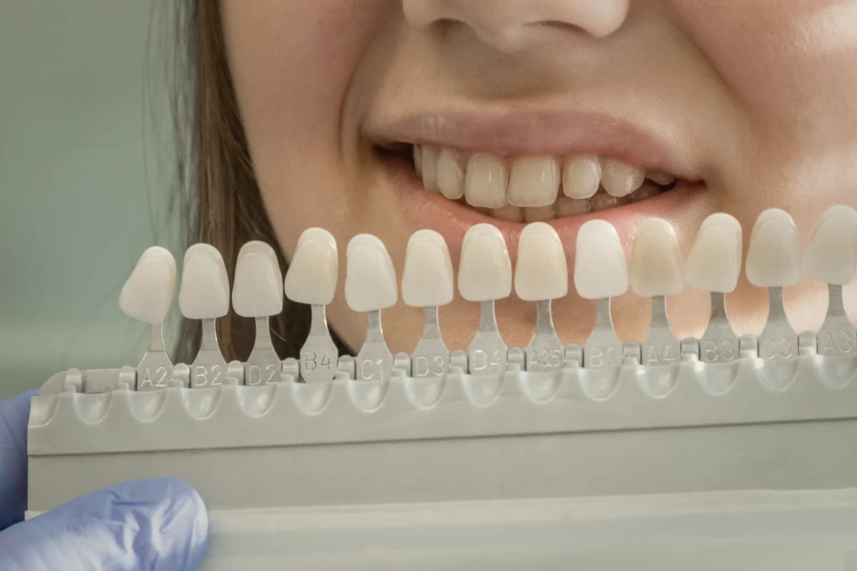 Veneer preparation scene with material samples and digital smile design