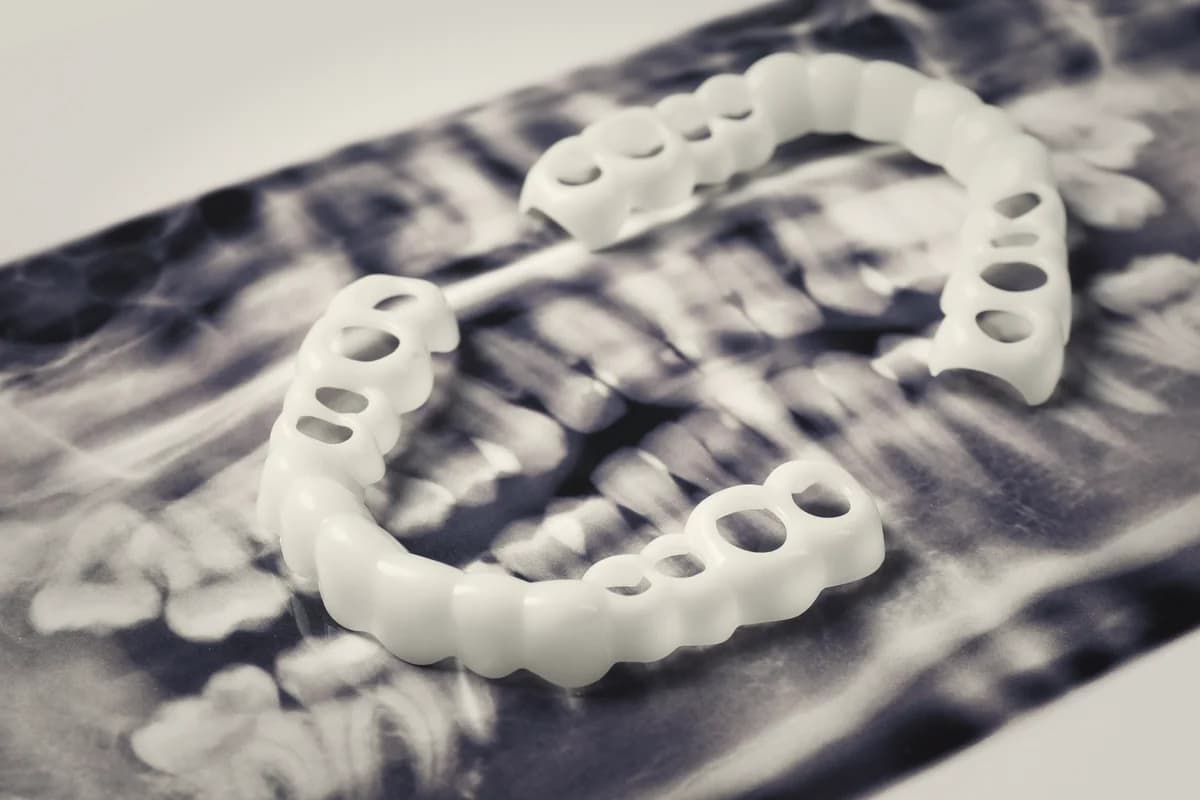 Implant prosthetic delivery stage — final crown and abutment on the surgical tray ready for fitting
