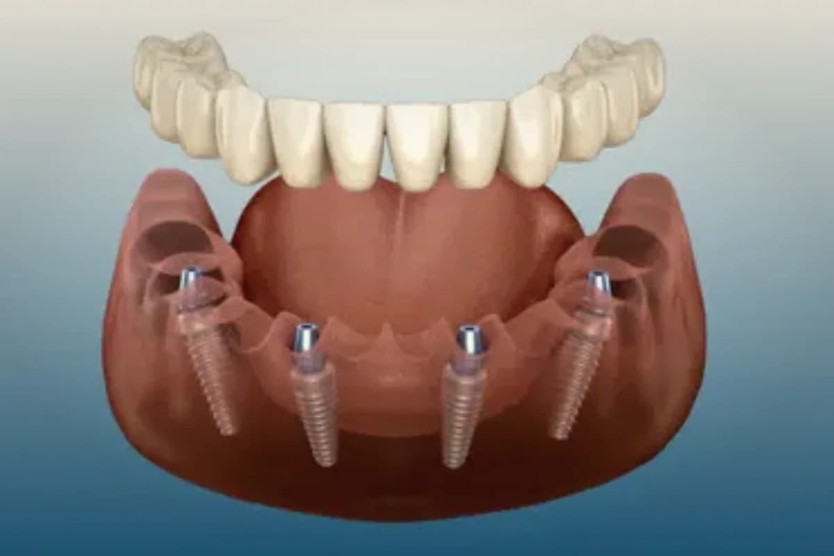 E-max and zirconia veneer material samples on a clinical worktop
