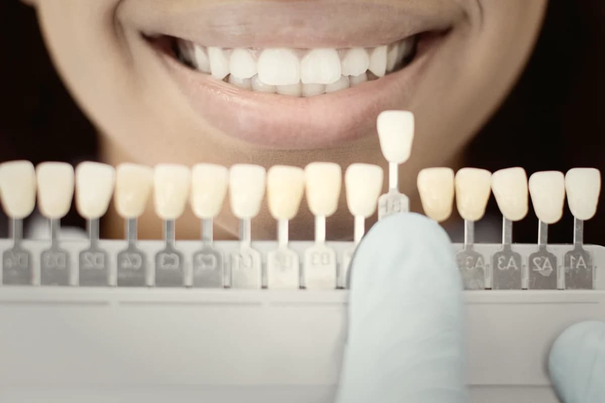 Aesthetic dentistry scene — veneer preparation stage at the chair-side workflow