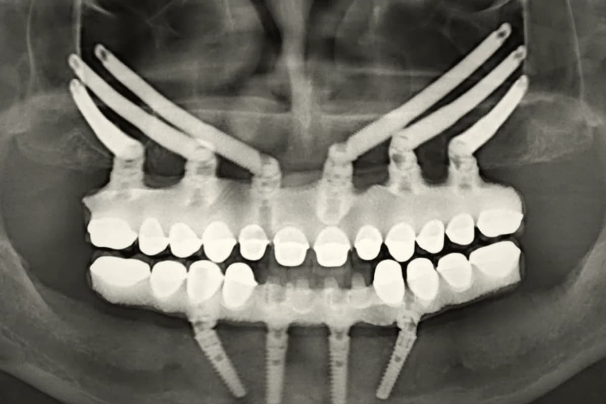Panoramic radiograph of implant-restored upper and lower jaws